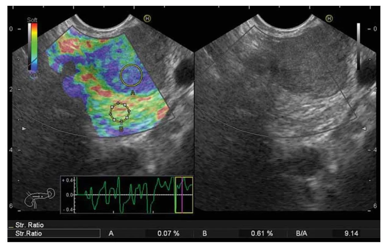 Porovnanie elasticity ložiska (A) a referenčnej oblasti – nepostihnutého parenchýmu pankreasu (B)
s výpočtom SR.<br>
SR – strain ratio, index elasticity. Zdroj: archív autora.<br>
Fig. 1. Comparison of the elasticity of the bearing (A) and the reference area – unaffected pancreatic parenchyma (B) with calculation
of SR.<br>
SR – strain ratio, elasticity index. Source: author‘s archive.