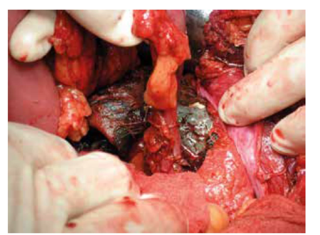 Colon sigmoideum<br>
Fig. 3: Colon sigmoideum