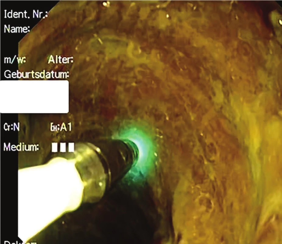 Správně kalibrovaná sonda (probe-based CLE) při vyšetření tenkého
střeva u pacientky po multiviscerální transplantaci s totální denudací epitelu<br>
Fig. 2: Correct calibration of the probe (probe-based CLE) during endoscopy
of the small intestine in a female patient treated by multivisceral transplantation
with total denudation of the epithelium