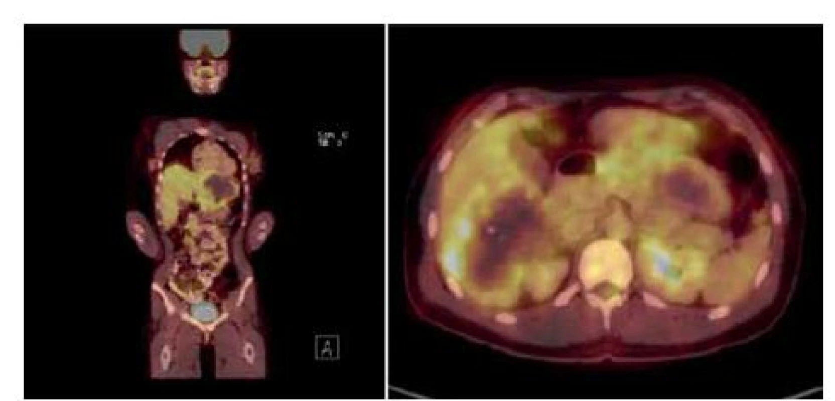 PET/CT scans prior to surgical intervention