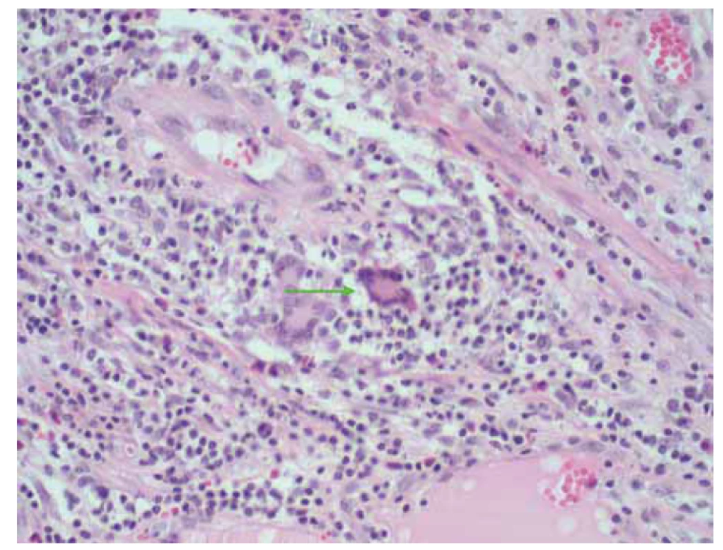 Histopatologický preparát, šipka – Langhansova buňka.<br>
Fig. 1. Histopathological tissue section, arrow – Langhans cell.