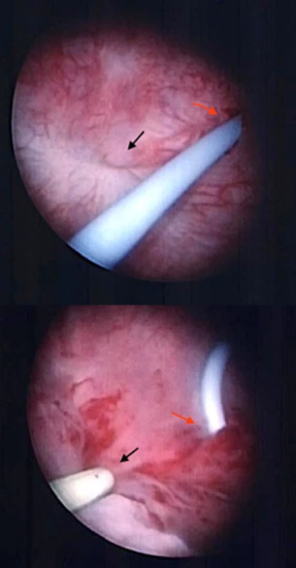 a, b. a) Typický nálevkovitý vzhled píštěle během cystoskopie (černá šipka), stent zavedený do levého
ureteru (červená šipka); b) sondáž píštěle ureterálním
katétrem usnadňuje manipulaci a orientaci v průběhu
výkonu (černá šipka), stent zavedený do levého ureteru
(červená šipka)<br>
Fig. 6 a, b. a) Typical funnel-shaped appearance of the
fistula during cystoscopy (black arrow), stent inserted in
the left ureteric orifice (right arrow); b) ureteral catheter
inserted in the fistula to aid manipulation and navigation during surgery (black arrow), stent inserted in the left
ureteric orifice (right arrow)
