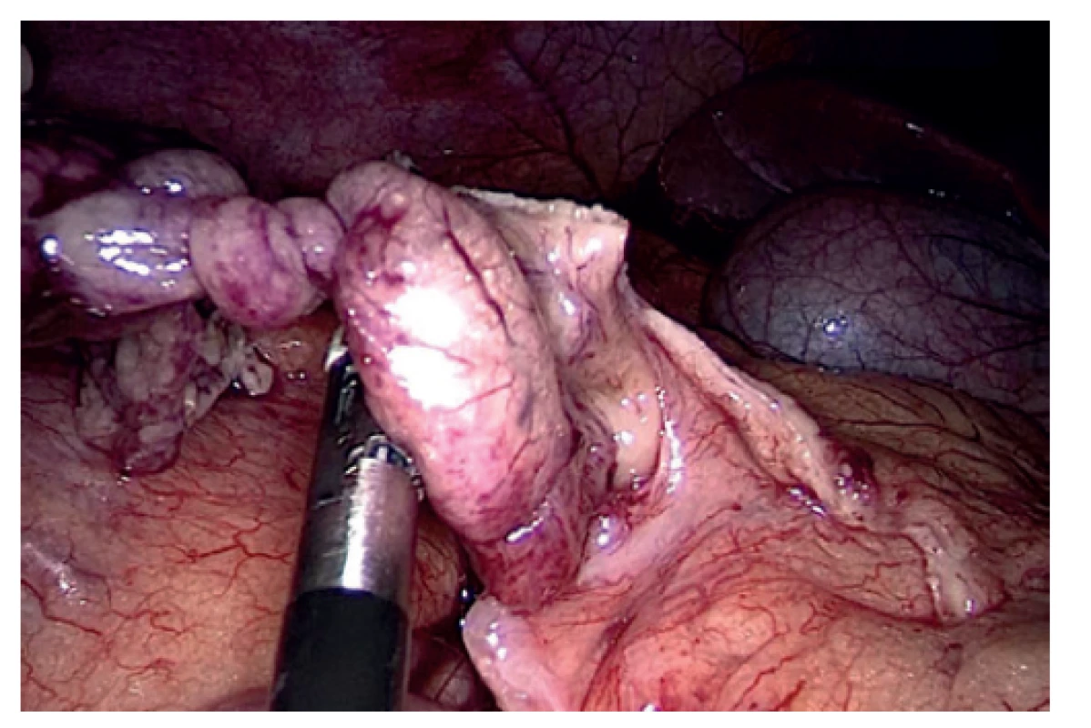 Vizualizace místa torze omenta<br>
Fig. 2: Visualization of the site of omental torsion