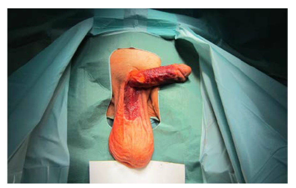 Granulační tkáň jeden měsíc po nekrektomii
kožního krytu penisu, předkožky i penoskrotální oblasti<br>
Fig. 4. Granulation tissue one month after necrectomy of
the penile skin, prepuce, and penoscrotal region