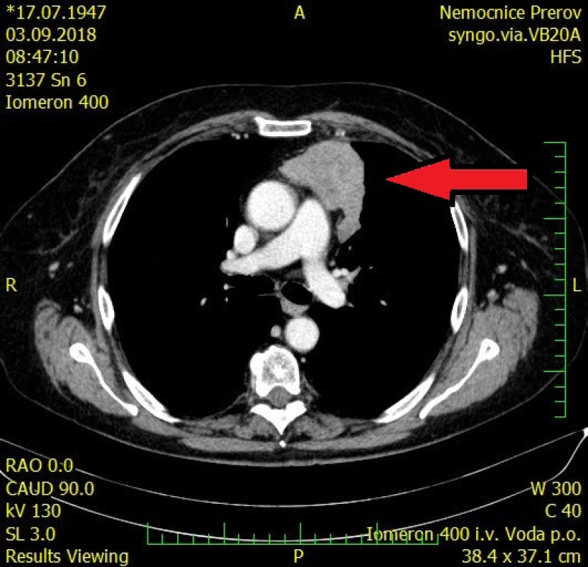 CT vyšetření hrudníku a břicha s kontrastní látkou, transverzální řez, tumor předního mediastina – šipka