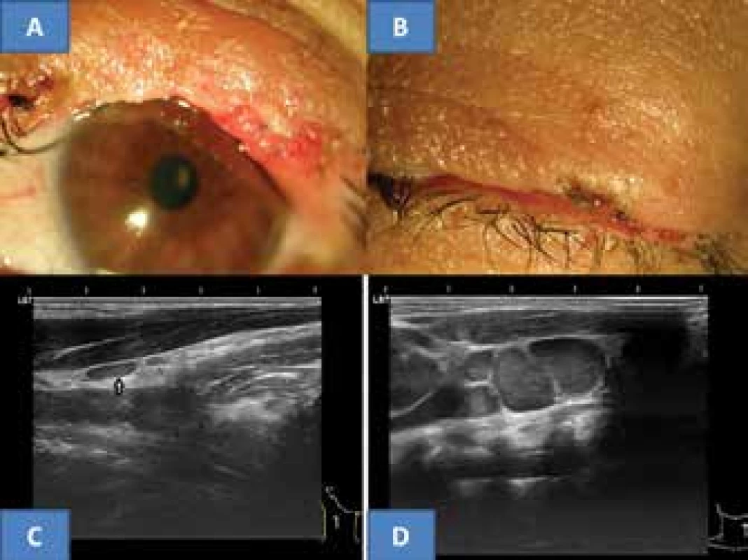 Clinical finding of upper eyelid five years after surgery for MCC
on now 53 year old patient (A), spontaneous closure of ocular aperture
(B), typical flat benign reactive node in area of musculus sternokleidomastoideus
in right eye in our patient (C) and for comparison example
of bundle of malignant predominantly almost spherical nodes with clear
echogenic stroma (archive of MUDr. J. Zikmund, CSc.) in same region (D)
