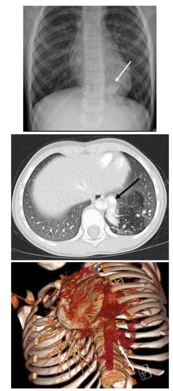 A. RTG plic, PS LDL, náhodný nález při kontrolním
snímku pro pravostrannou pneumonii.<br>
Fig. 6A. X-ray of the lungs, PS in left lower lobe, accidental
finding on control X-ray being done for the pneumonia in the
other side.<br>
Obr. 6B. CT plic, transverzální řez, PS LDL s mohutnou přívodnou
tepnou odstupující z hrudní aorty.<br>
Fig. 6B. CT of the lungs, transversal cut, PS in left lower lobe
with a huge artery supply from the thoracic aorta.<br>
Obr. 6C. CT plic, angiografie, 3D rekonstrukce.<br>
Fig. 6C. CT of the lungs, angiography, 3D reconstruction.