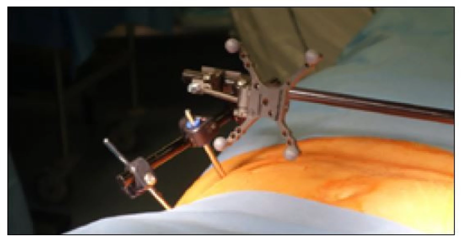 Navigační sonda fixována na tělo zevního fixátoru pánve pomocí
spinózního fixátoru