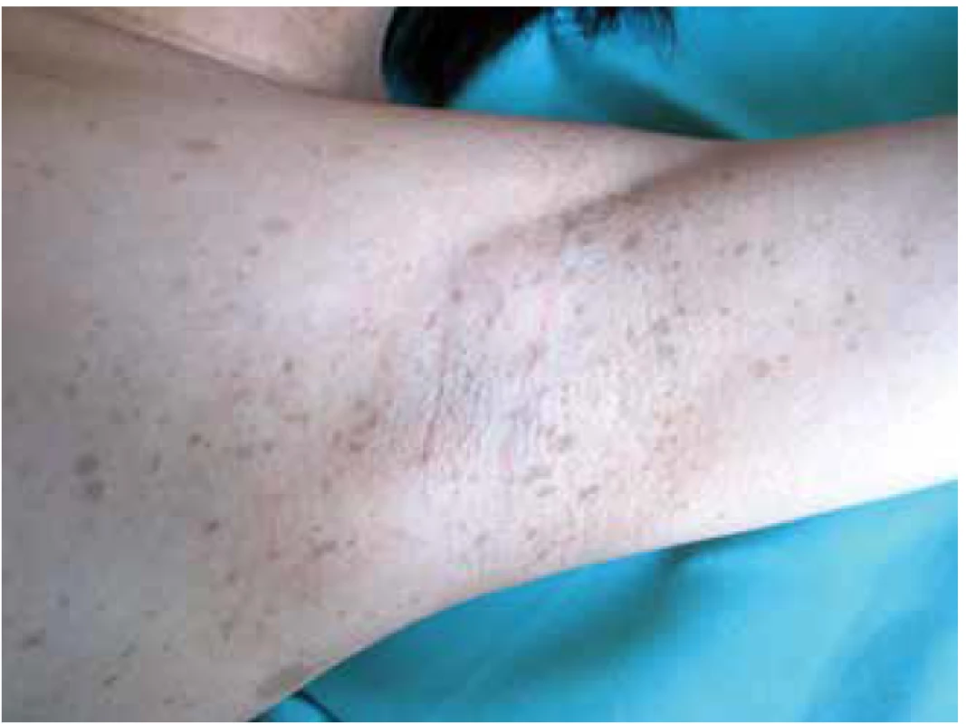 Freckling v podpaží<br>
Zdroj: Pediatrická klinika LF MU a FN Brno