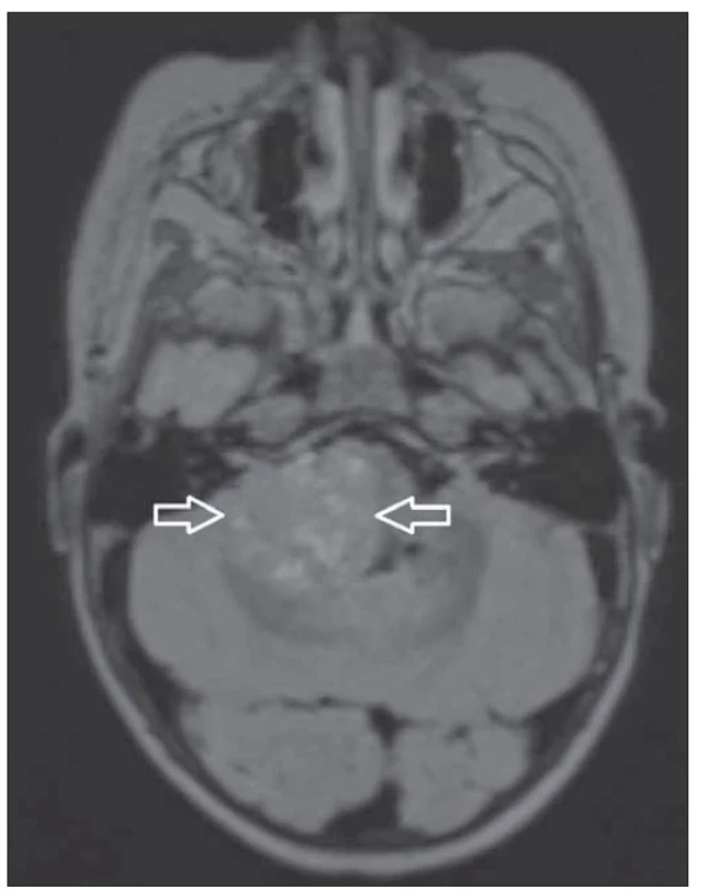 T2 vážený FLAIR axiální sken 1mm – multiplanární rekonstrukce
z 3D FLAIR, intraaxiální tumor zadní jámy.<br>
FLAIR – fluid attenuated inversion recovery<br>
Fig. 4. T2-weighted 1-mm FLAIR axial scan 1mm – multiplanar
reconstruction from 3D FLAIR, intraaxial posterior fossa tumour.<br>
FLAIR – fluid attenuated inversion recovery