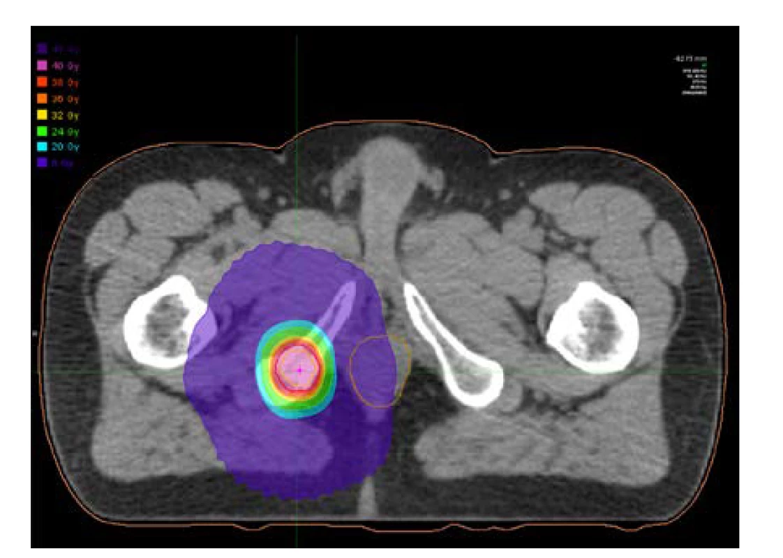 Plánovací CT s izodózami – solitární metastáza
v dolním raménku kosti stydké vpravo<br>
Fig. 2. Planning CT with isodoses – solitary metastasis
in the inferior ramus of the right pubic bone