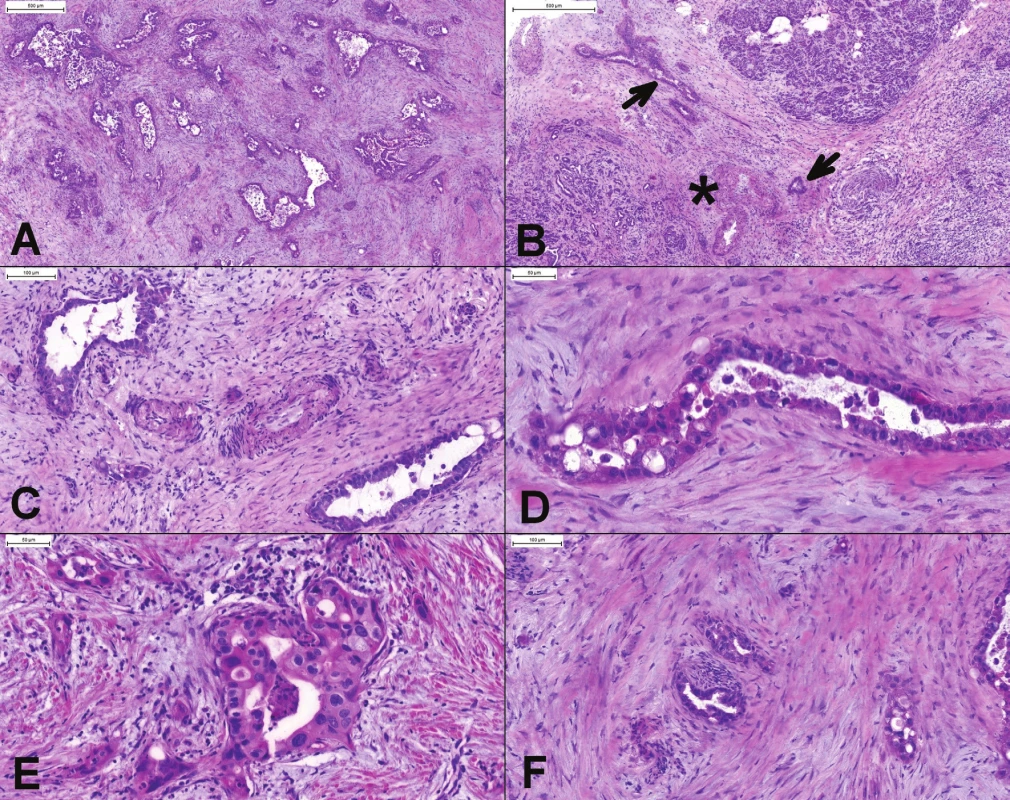(A) Duktálny karcinóm pankreasu. Vo väčšine prípadov je diagnóza ľahká. Chaoticky usporiadané žliazky s cytologickými
atypiami a debris v lúmenoch sú jednoznačnou známkou malignity. (B, C) Žliazky karcinómu lokalizované vo fibrotických
interlobulárnych septách (), v blízkosti muskulárnych artérií (*). V normálnom pankrease dukty a väčšie cievy nikdy
nemajú spoločný priebeh. (D) Nekrotický debris v atypickej žliazke. (E) Variácia veľkosti jadier 4:1, inkopletne formované žliazky
a infiltrácia po jednotlivých bunkách. (F) Perineurálna invázia