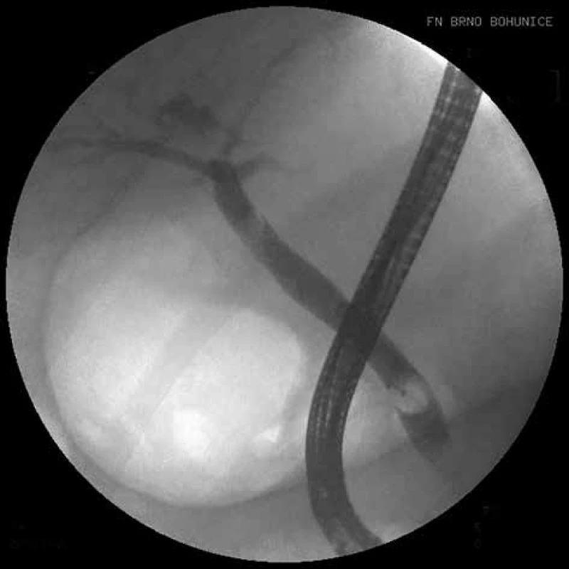 ERCP, stav po extrakci litiázy extrakčním košíkem
a balonkem<br>
Fig. 2: ERCP, condition after the extraction of lithiasis by
an extraction basket and balloon