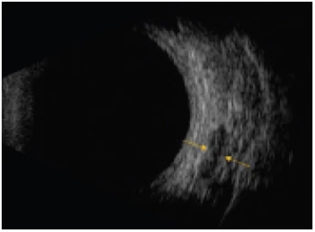 Probe position in B-scan, longitudinal view – when examining
the rectus muscle, the probe mark points towards the
cornea