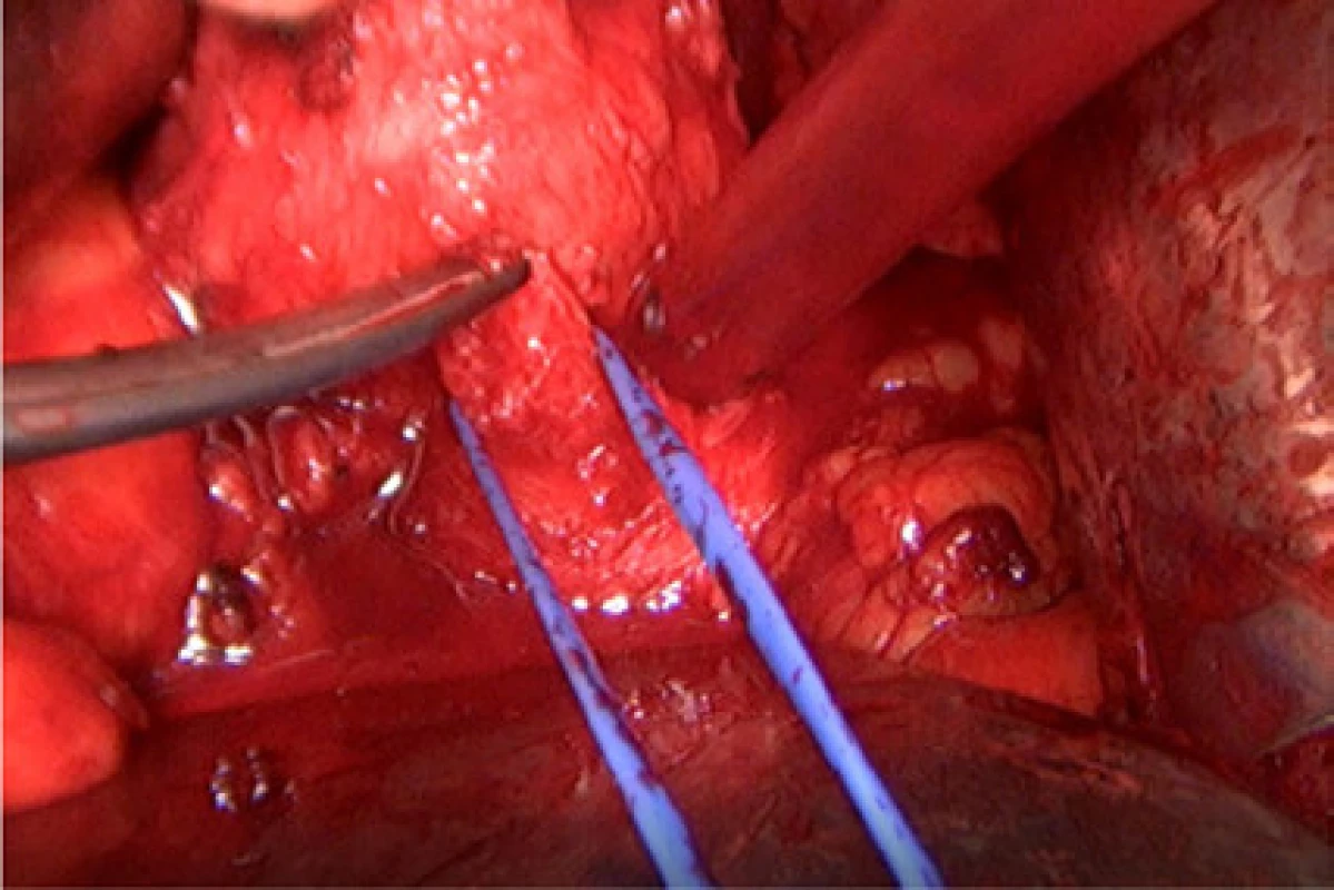 Zahájení přerušení prostatické uretry na močovém katétru ostře nůžkami<br>
Fig. 4. Initiation of transection of the prostatic urethra
on a urinary catheter sharply with scissors 