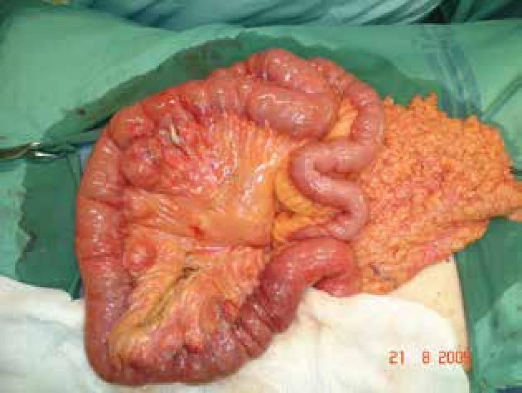 Tenké střevo s divertikly<br>
Fig. 1: Small bowel with diverticula