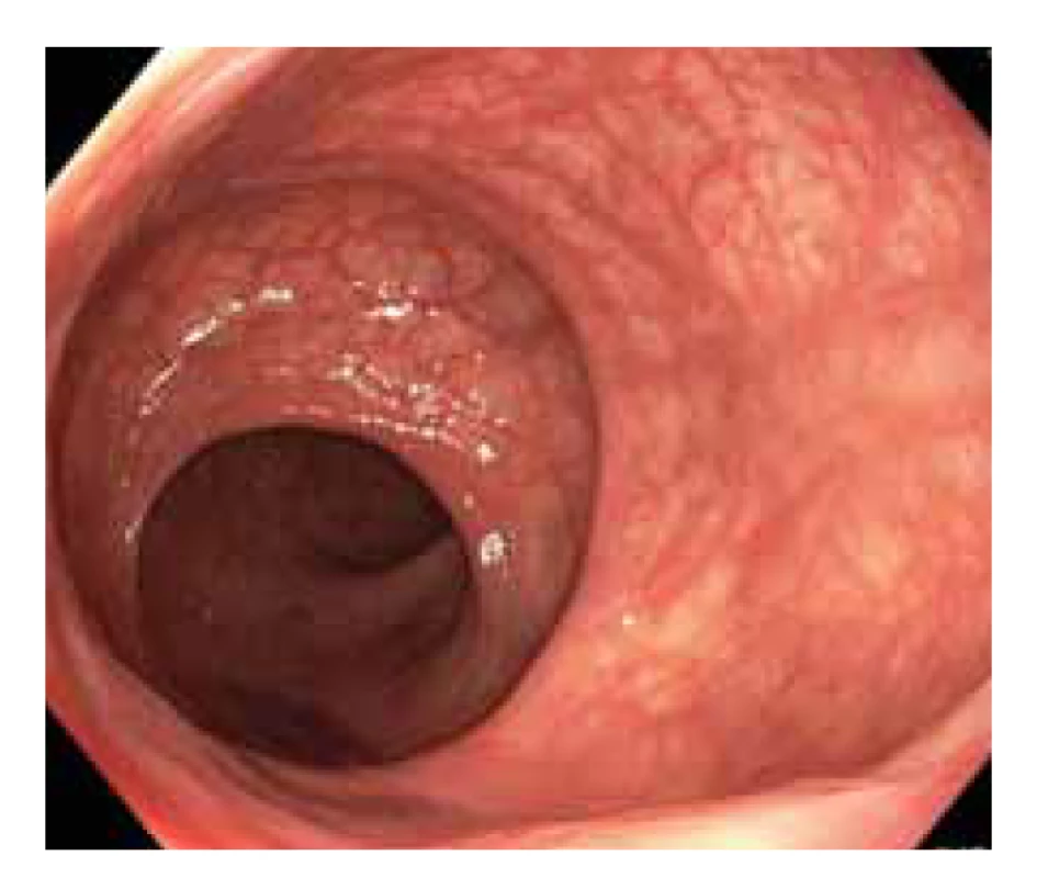 Normální nález na sliznici
rekta a rektosigmatu.<br>
Fig. 1. Normal finding on the mucosa of 
the rectum and rectosigma.