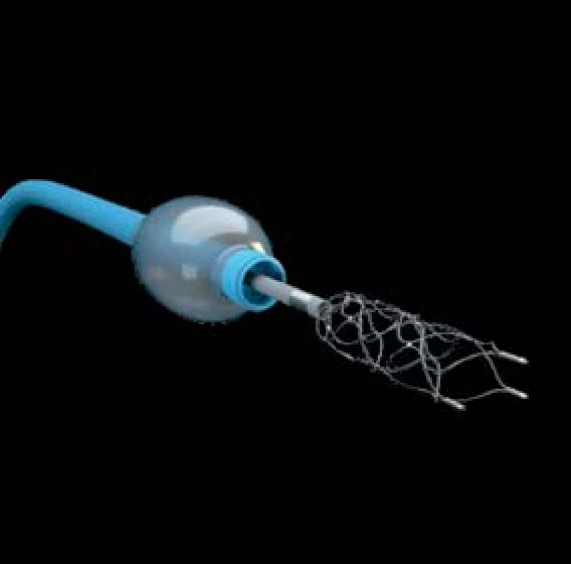 Okluzivní balónkový katétr Cello
se zavedeným mikrokatétrem
a částečně otevřeným stent-retrieverem