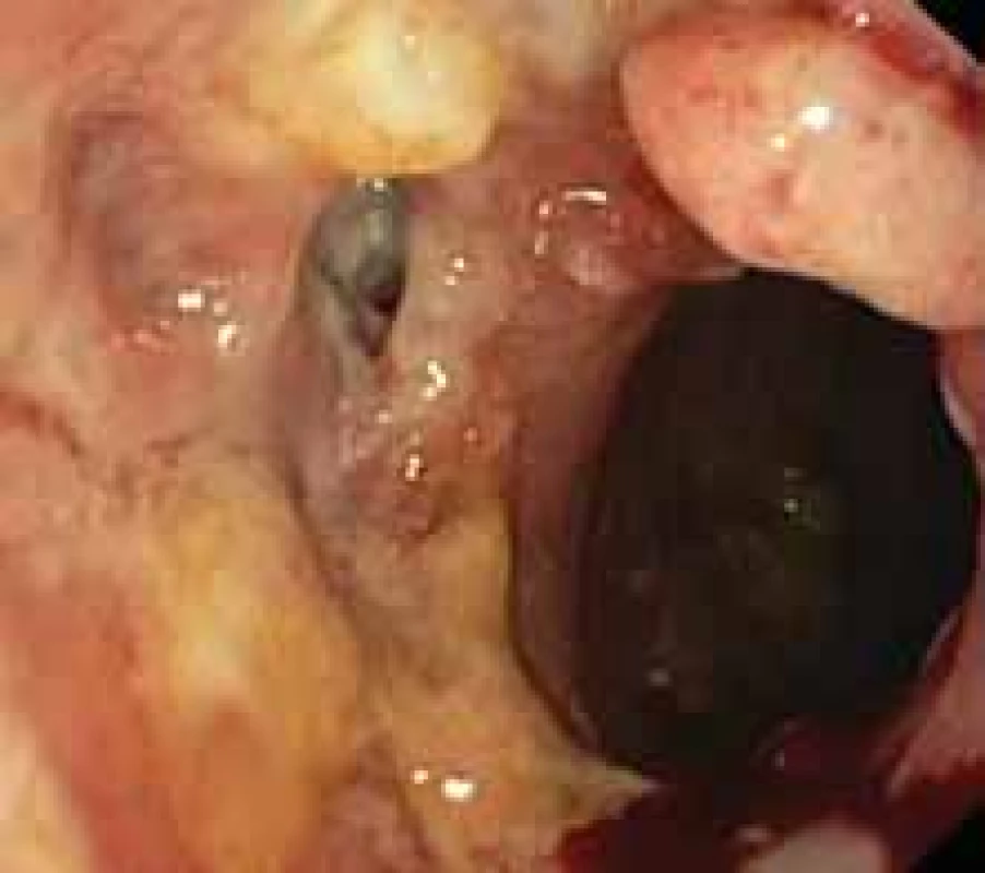 Persistent leakage following
stent extraction in post-sleeve gastrectomy condition.
Obr. 9. Perzistující leak po extrakci stentu při stavu po sleeve gastrektomii.