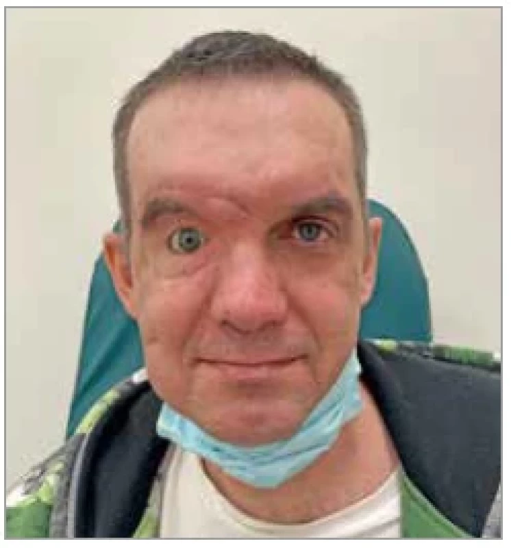 Appearance of the whole
patient’s face with final eye’s
prosthesis 6 months after the first
operation at our department.