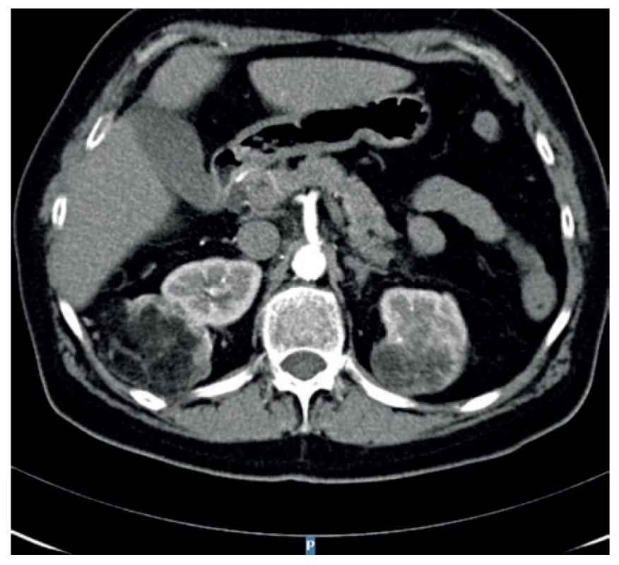 Bilaterální angiomyolipomy na CT břicha<br>
Fig. 1: Bilateral angiomyolipomas on abdominal CT