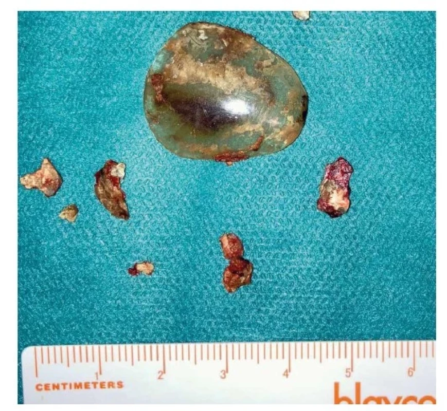 Fotografie extrahovaných cizích předmětů z dutiny
nosní<br>
Fig. 3: Photo of foreign objects extracted from the nasal
cavity