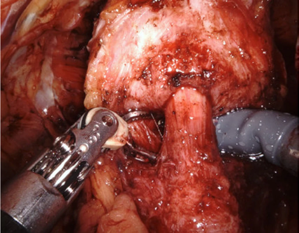 Detail kompletně uvolněného hrdla<br>
Fig. 3. Detail of the bladder neck having been separated
completely