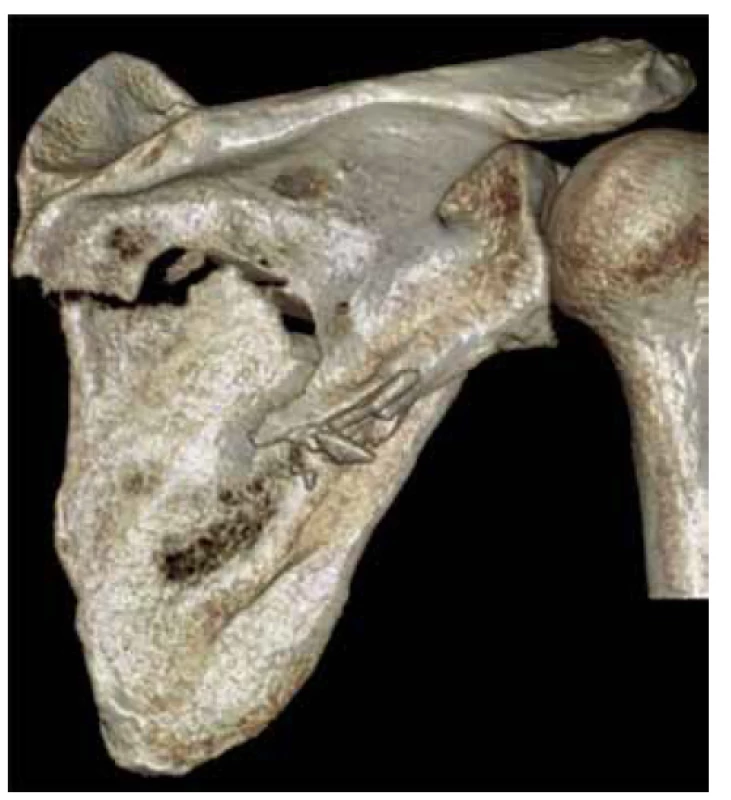 3D CT reconstruction, posterior view - two-part
infraspinous scapular body fracture. The same fracture
pattern presented by Cole et al. as “a fracture of scapular
neck” (Ref. [12]).