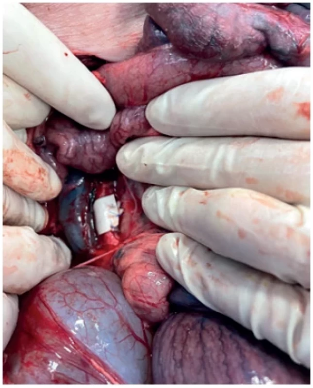Arterial band on subrenal aorta of the pig