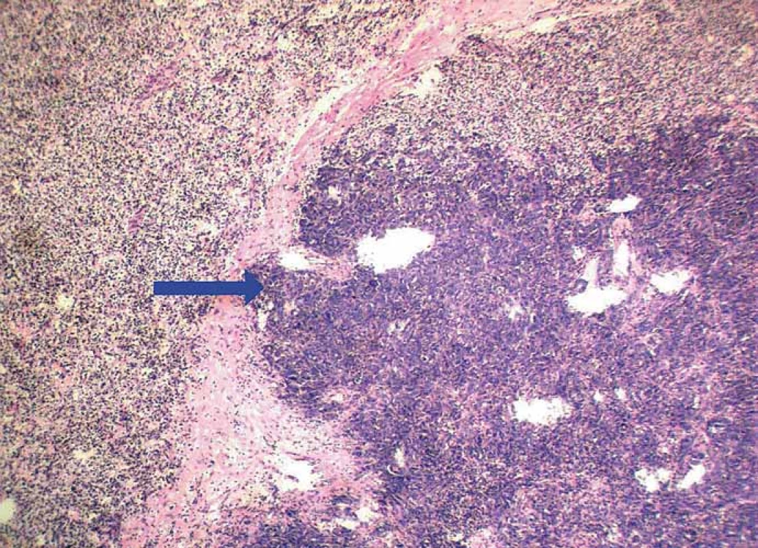 Conventional clear cell RCC (left and upper part) harboring a metastasis of adenocarcinoma
(blue arrow) (hematoxylin & eosin, magnification 100×).
