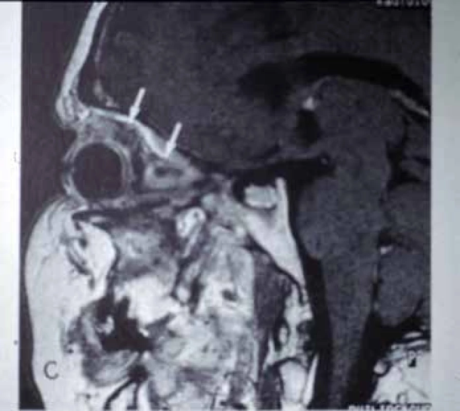 Granulomatóza s polyangiitidou – zánětlivé granulomy v orbitě  (šipky).