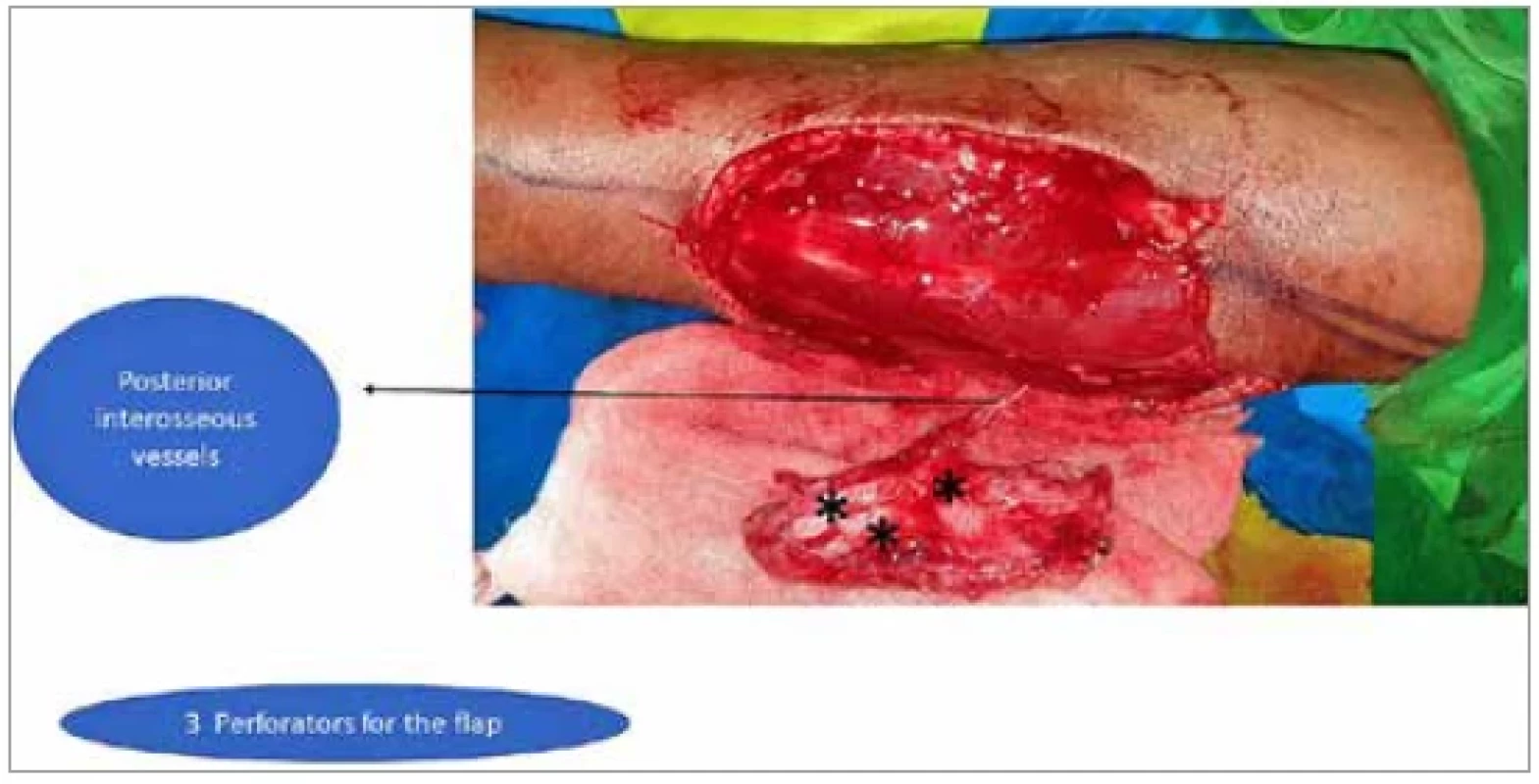 The posterior interosseous flap is harvested. The posterior interosseous
vessel is indicated by the arrow and the perforators are indicated by asterisks.