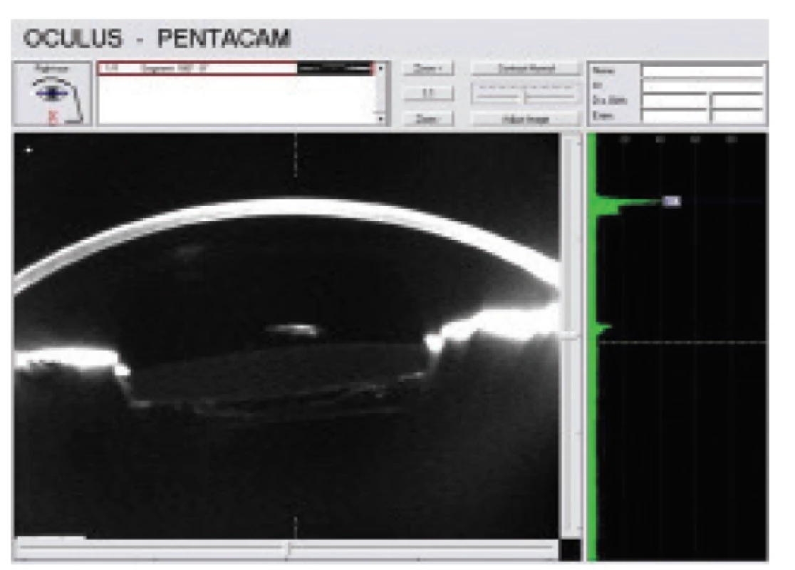 Scheimpflug photograph after lavage documents
frilled posterior capsule, space behind IOL now without
opalesque liquid and posterior capsule adheres to
posterior surface of IOL. Anterior hyaloid membrane is
displayed behind capsule.