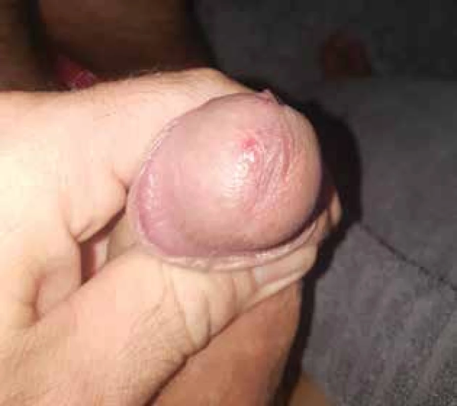 Ulcus durum
