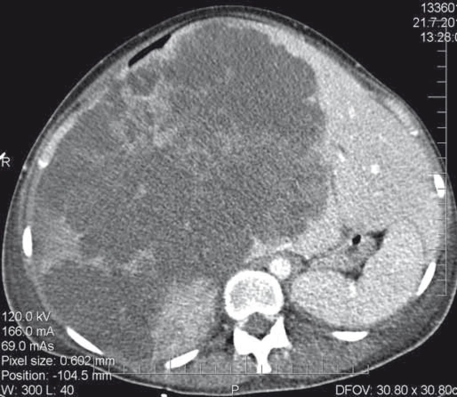 CT nález neoperabilního nálezu.<br>
Fig. 3. CT scan of an inoperable finding.
