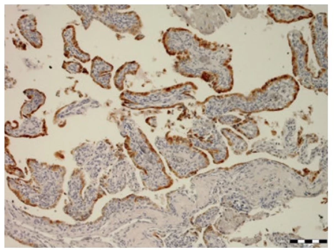 Imunohistochemický průkaz EMA (zvětšení 100x).