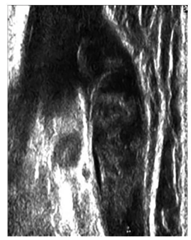 Endovenózní teplem indukovaná trombóza<br>
Fig. 5: Endovenous heat-induced thrombosis