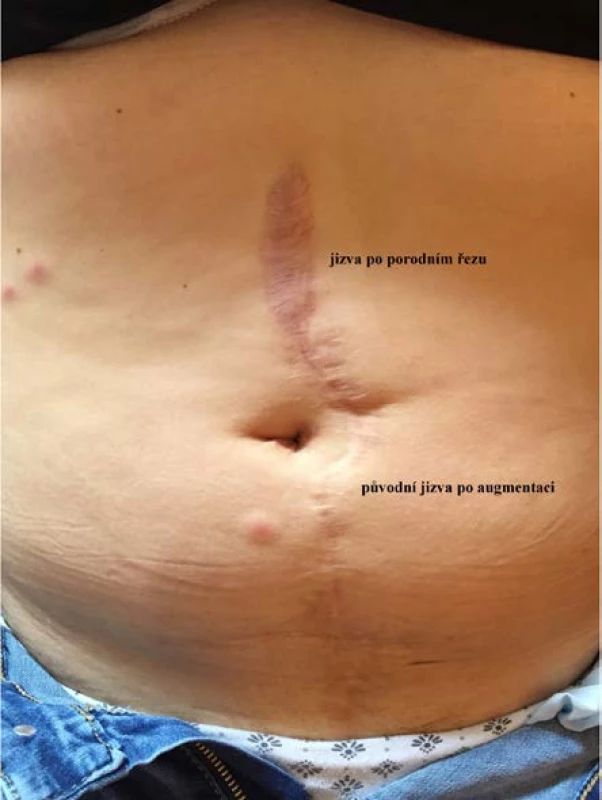 Pohled na břišní stěnu identické nemocné
po porodu: kraniálně od pupku je jizva po provedeném porodním řezu, pod pupkem původní jizva po
augmentaci<br>
Fig. 3. View of the same patient’s abdominal wall
after delivery: a scar cranially from the umbilicus after
obstetric incision; the original scar after augmentation below the umbilicus