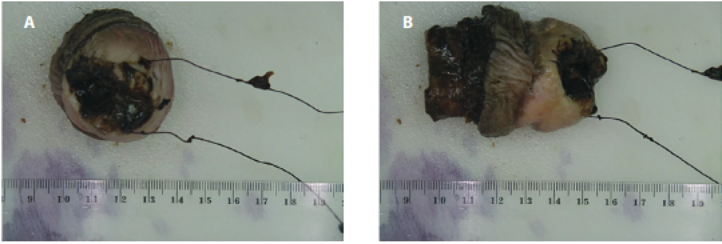 a–b. Amputát distální části penisu; je patrný klínovitý defekt po předchozí excizi vzorku tumoru<br>
Fig. 1 a–b. An amputate of the distal part of the penis; a wedge-shaped defect is evident after previous
excision of the tumor sample