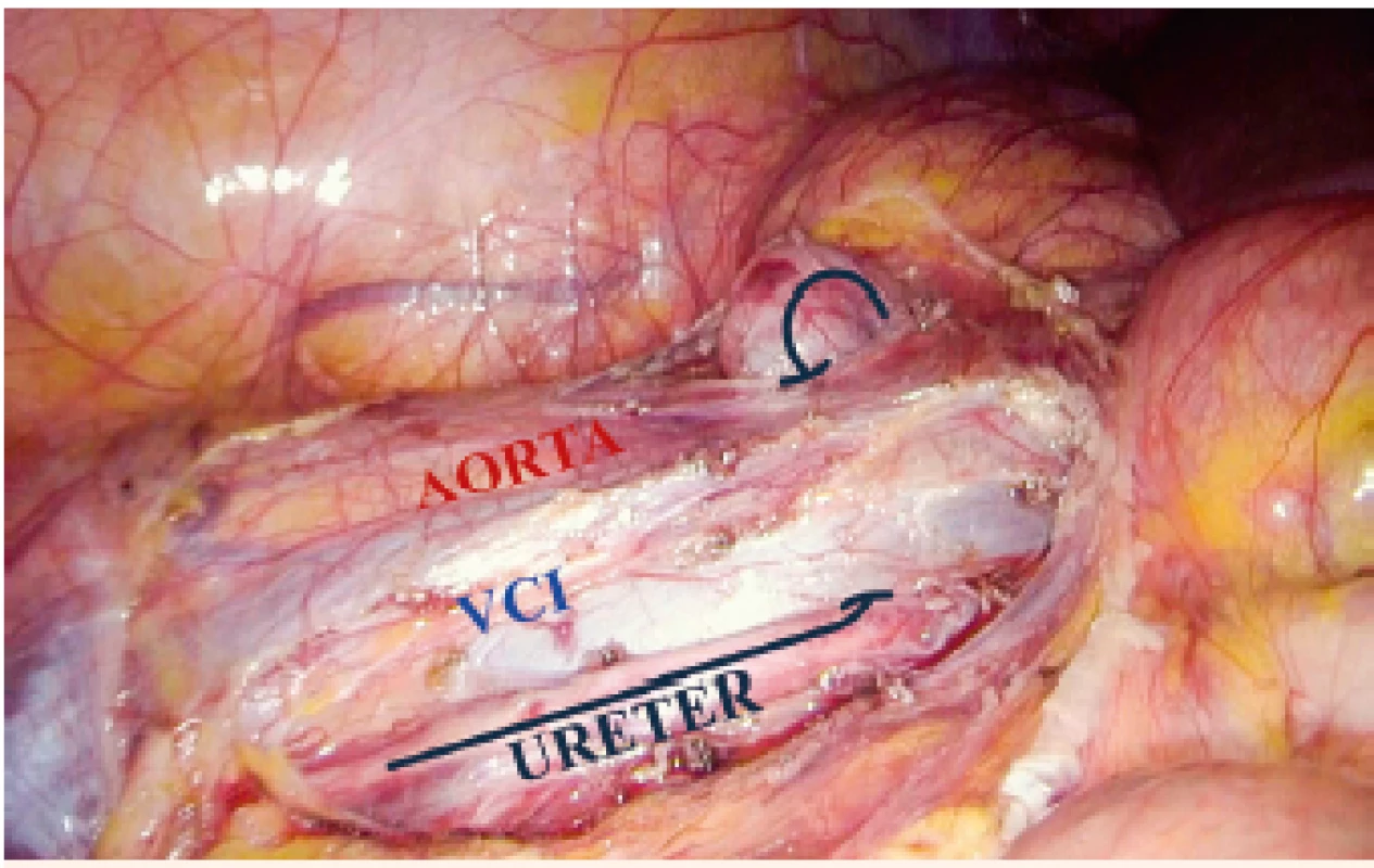 Situace po vypreparování proximálního i distálního úseku močovodu. Močovod je stále uložen za dolní dutou žílou.<br>
Dissection of the proximal and distal part of right ureter. The ureter is still located behind the inferior vena cava.