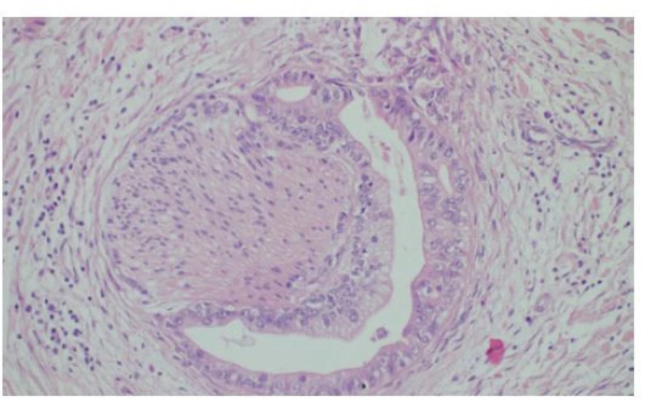 Histologie cholangiocelulárního adenokarcinomu
tubulární stavby, který infiltruje okolo nemyelinizovaného
periferního nervu v hilu jater, HE, 200×<br>
Fig. 6: Histology of cholangiocellular adenocarcinoma
characterized by tubular arrangement, infiltrating a nonmyelinated
peripheral nerve in the liver hilum, HE, 200×