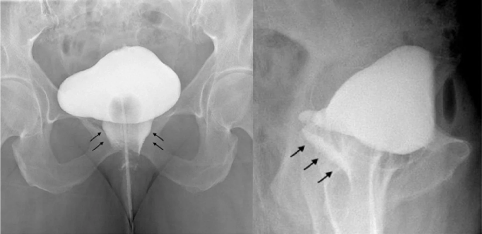  a, b. Předozadní a laterální projekce cystografie prokazuje únik kontrastní látky do pochvy (šipky)<br>
Fig. 4 a, b. Anteroposterior and lateral view of the urinary bladder during cystography demonstrates urine leak and
vesicovaginal fistula (arrows)