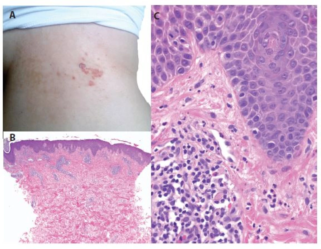 a, b, c. Prurigo pigmentosa<br>
a) bioptovaná makulopapula
na boku<br>
b) perivaskulární dermatitida
(HE 40x)<br>
c) v epidermis nevýrazná
spongióza, ojedinělá
lymfocytární exocytóza,
v koriu perivaskulární
lymfocytární
infiltráty s příměsí
neutrofilů se známkami
fragmentace jader
přítomných v lumen
cév a pronikajících do
papil, ojedinělé eozinofily
(HE 400x)