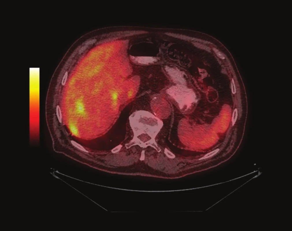 PET/CT trupu<br>
Fig. 5: PET/CT of the trunk