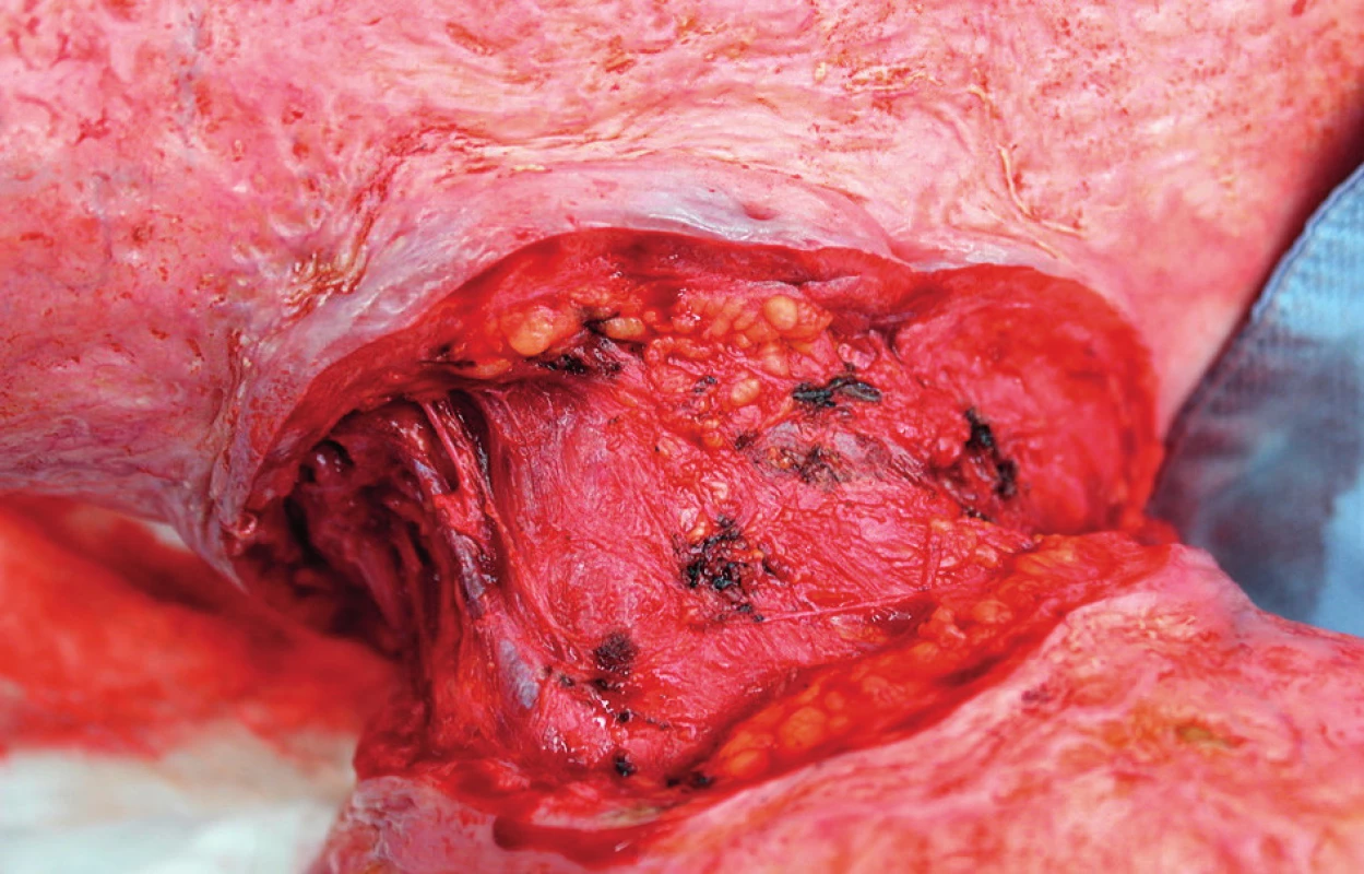 A hypertrophic scar incision for releasing neck adhesion (exposed outermost layer of the external jugular vein) after a burn trauma