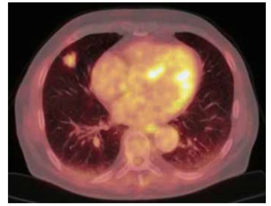 18F-FDG PET/CT vyšetření hrudníku před resekcí suspektního
ložiska – zobrazuje se mírně zvýšená akumulace FDG v ložisku v S4 pravé
plíce ventrálně velikosti 19 x 20 x 17 mm (SUVmax 3,3)