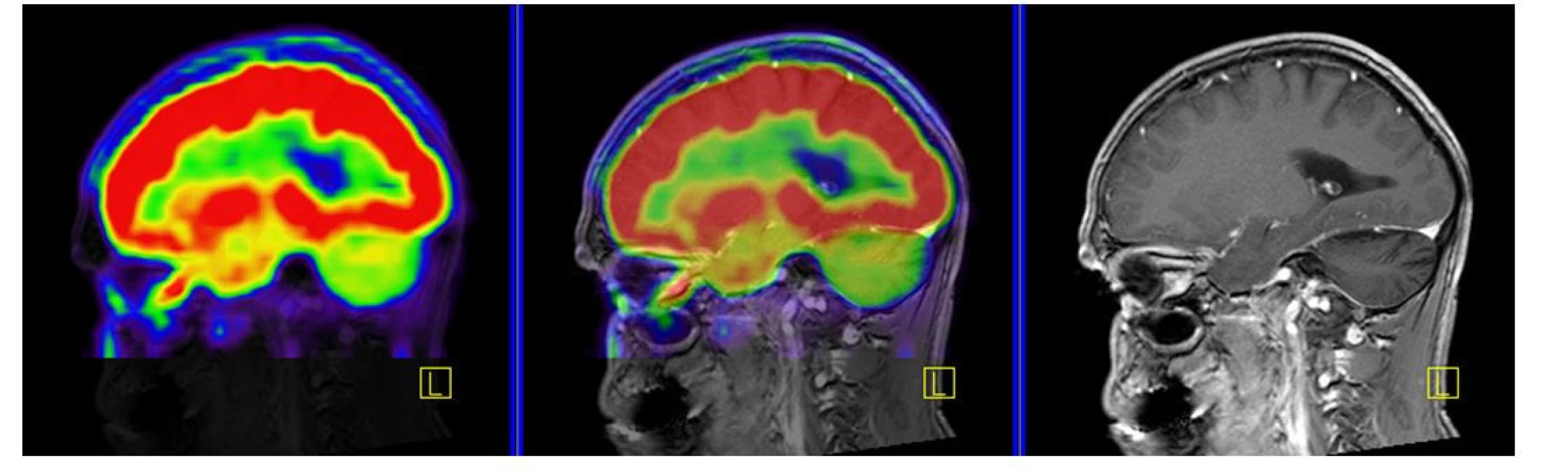 PET CT zobrazení mozku, červená barva znázorňuje intenzivní akumulaci fluorodeoxyglukózy (FDG), zatímco zelená barva odpovídá snížené
akumulaci FDG. V oblasti cerebella, které je postiženo neurodegenerativními změnami, je zřetelné výrazně snížené vychytávání FDG a neurodegenerativní
změny byly u tohoto pacienta zřetelné i na MR zobrazení