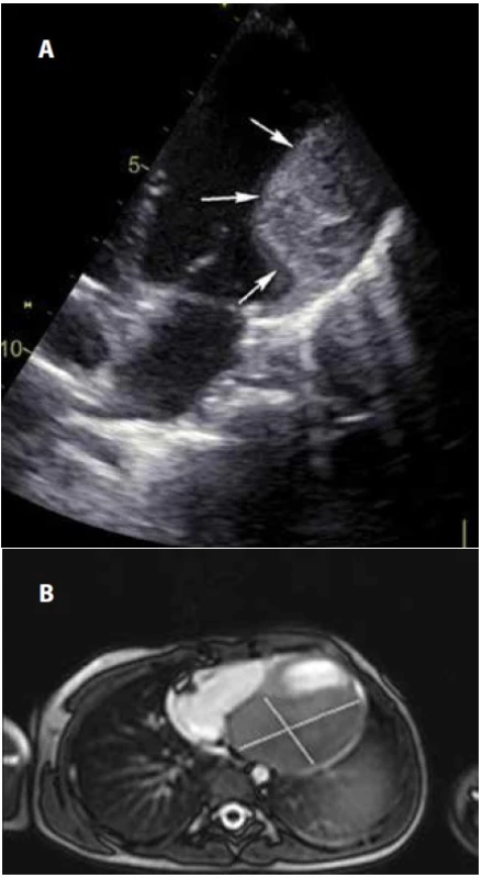 Fibrom postnatálně, echokardiografie (a) a magnetická
rezonance (b).<br>
Fig. 3. Postnatal fibroma, echocardiography (a), and magnetic
resonance imaging (b).