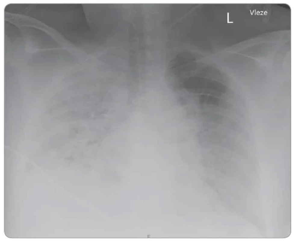 Chest X-ray of patient 2.