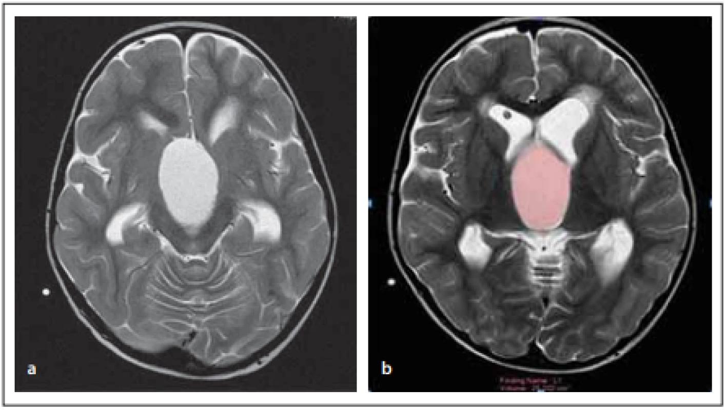 Female patient (6-year-old) – (A) the cystic component of the lesion in the axial 
T2 images; (B) the volume measurement of the cystic component of the lesion in the 
axial T2 images.<br>
Obr. 1. Pacientka (6 let) – (a) cystická komponenta léze na T2 zobrazení v axiální rovině; 
(b) měření objemu cystické komponenty léze na T2 zobrazení v axiální rovině. 